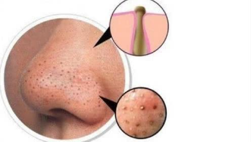  去黑头不再走弯路，三步让你摆脱草莓鼻！