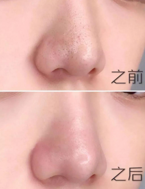  去黑头不再走弯路，三步让你摆脱草莓鼻！